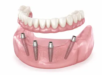 all on 4 fiksna proteza na implantatih