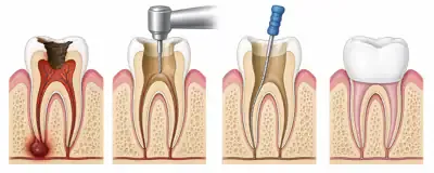 Shematski prikaz postopka endodontskega zdravljenja zobne korenine