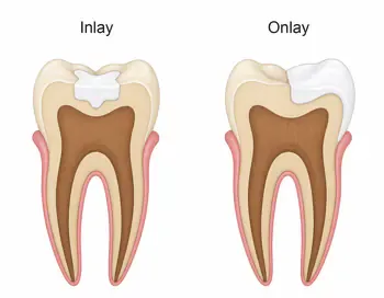 Inlay