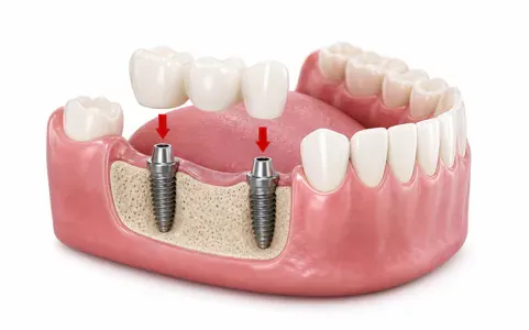 zobni implantat