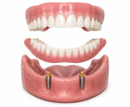 implantat All on 4