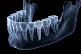 zobni implantat