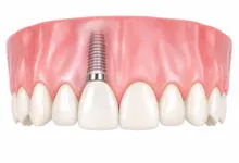 zobni implantat cirkon