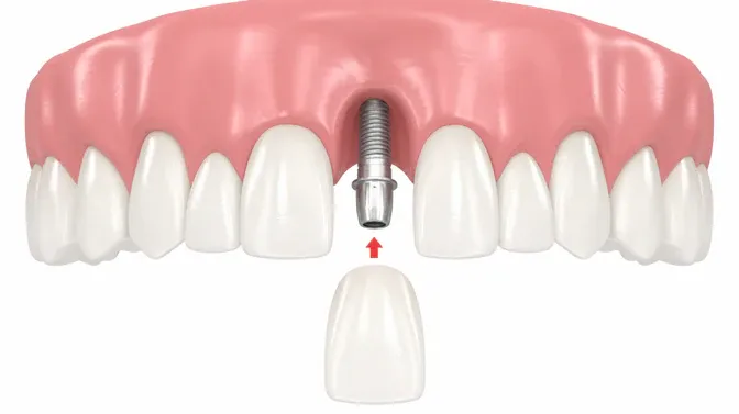zobni implantat
