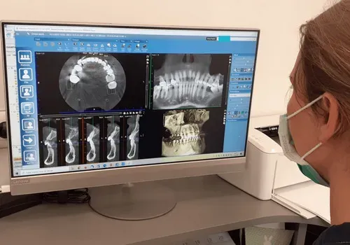 3D digitalno slikanje zob