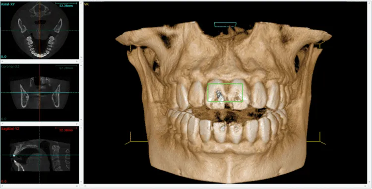 3D CBCT posnetek čeljusti in zob