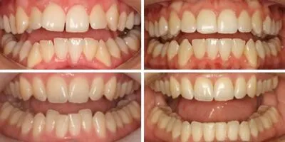 invisalign