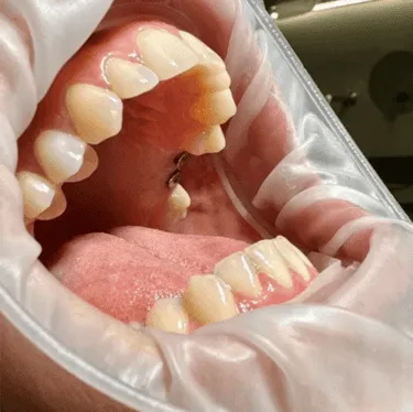 implantat brez krone
