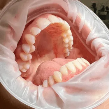 zobni vsadek implantat s krono