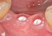 zobni implantant v dlesni